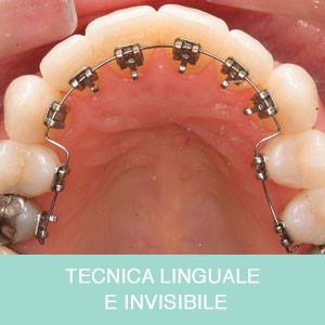 Tecnica linguale e invisibile a Galliate