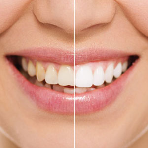 Sbiancamento Denti Galliate Novara