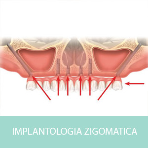 implantologia_zigomatica