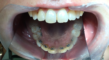 Terapia Linguale