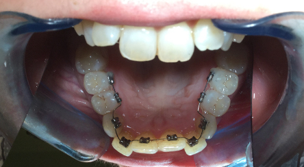 Terapia Linguale