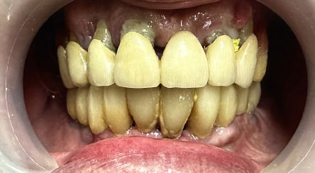 Impianti e denti fissi in 24 ore