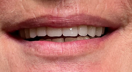 Impianti e denti fissi in 24 ore