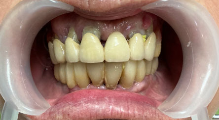 Impianti e denti fissi in 24 ore